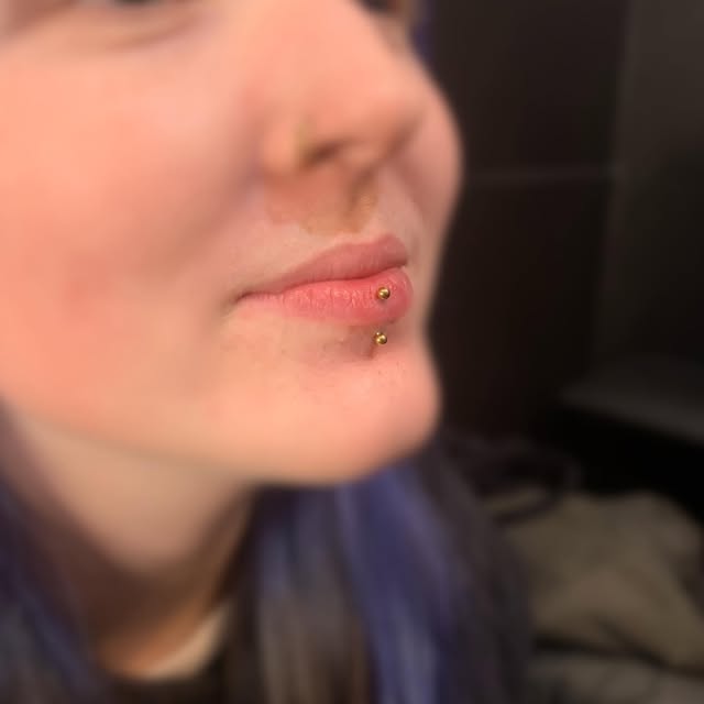 Frisch gestochenes Lippenpiercing mit goldenen Kugeln